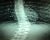 Spinal X-Ray