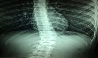 Spinal X-Ray